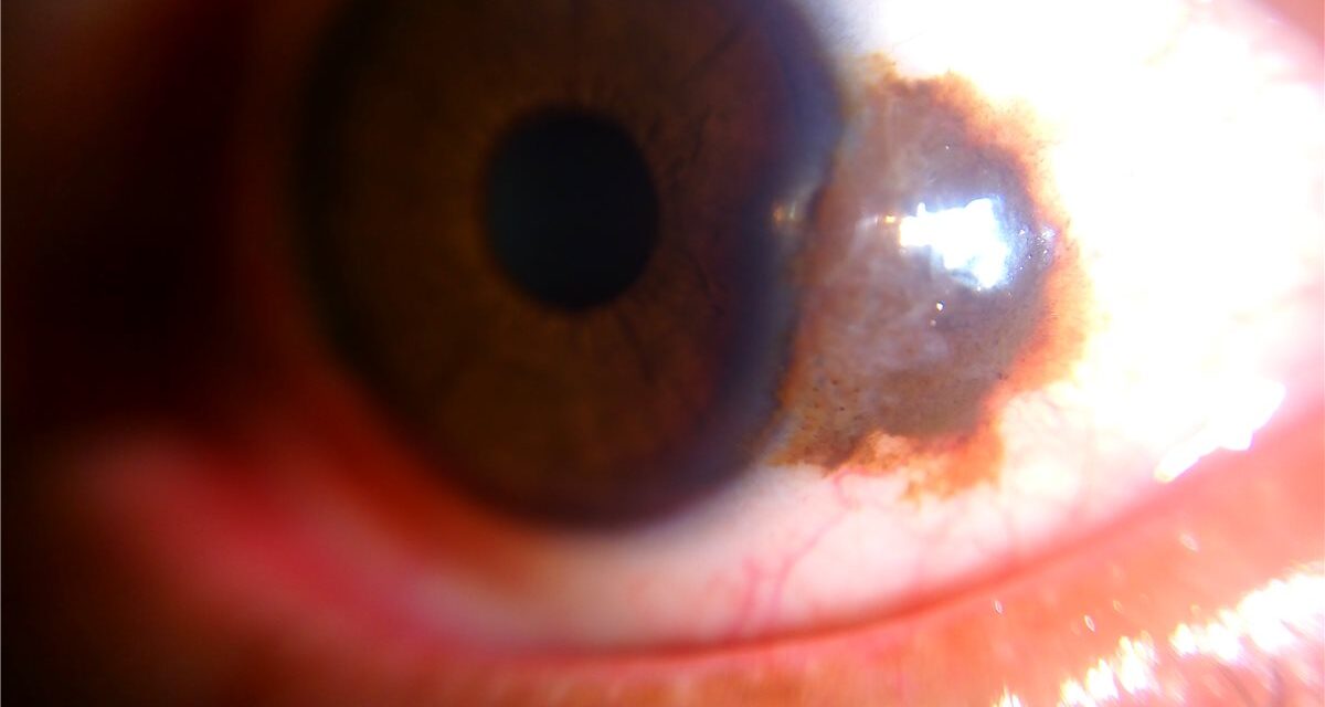 Conjunctival Nevus: Reading the Cysts That Tell You It Is Benign