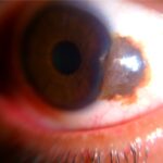 Conjunctival nevus: a slit-lamp photograph of a well-circumscribed, variably pigmented lesion at the limbus with visible cystic spaces, typical features that help distinguish a benign nevus from melanoma