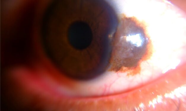 Conjunctival Nevus: Reading the Cysts That Tell You It Is Benign