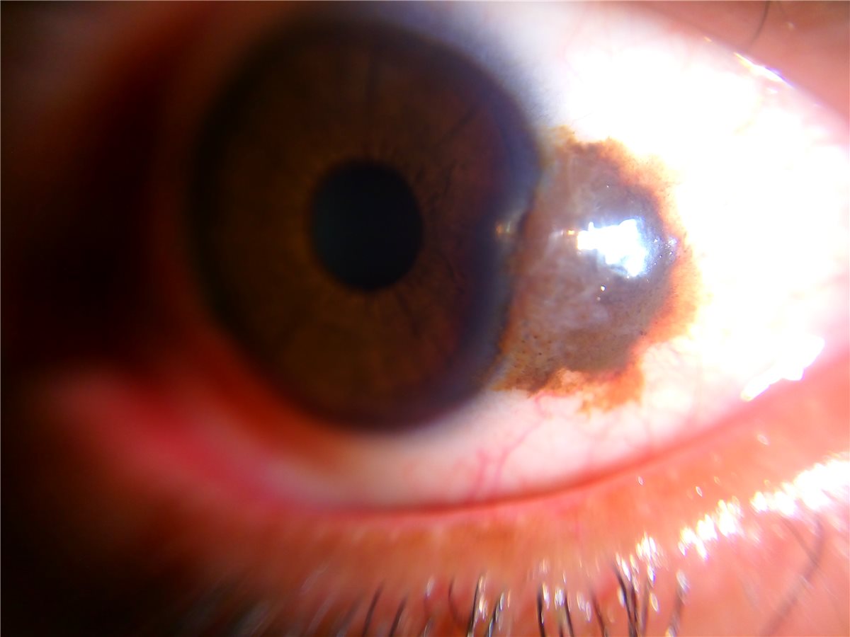 Conjunctival nevus: a slit-lamp photograph of a well-circumscribed, variably pigmented lesion at the limbus with visible cystic spaces, typical features that help distinguish a benign nevus from melanoma