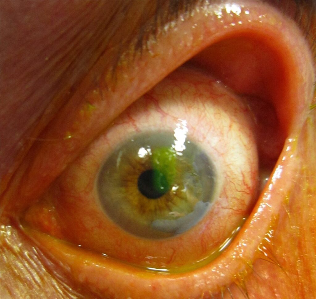 Corneal Abrasion: The Common Injury With Two Dangerous Mistakes