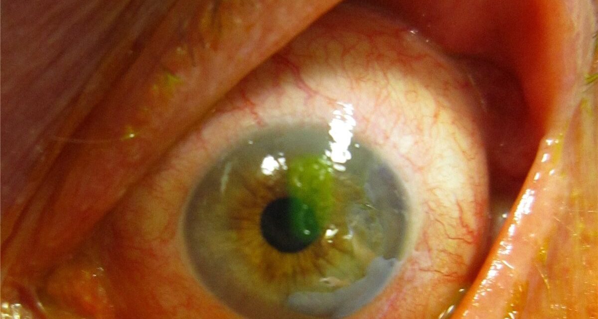 Corneal Abrasion: The Common Injury With Two Dangerous Mistakes