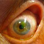 Corneal abrasion: a bright green corneal epithelial defect highlighted by fluorescein staining, with surrounding conjunctival injection