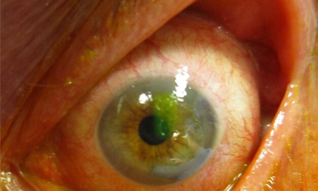 Corneal Abrasion: The Common Injury With Two Dangerous Mistakes
