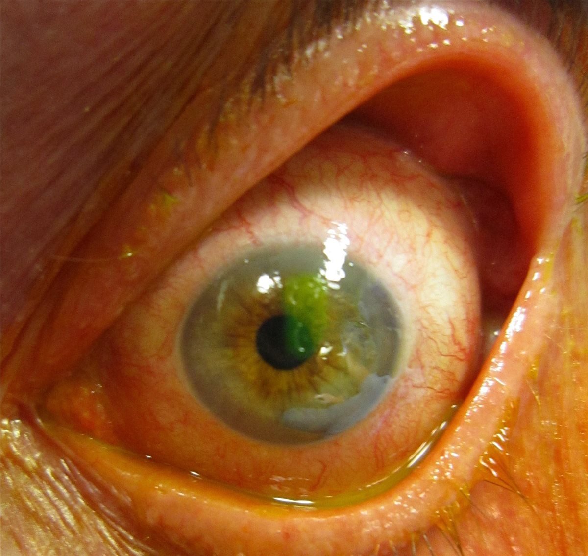 Corneal abrasion: a bright green corneal epithelial defect highlighted by fluorescein staining, with surrounding conjunctival injection