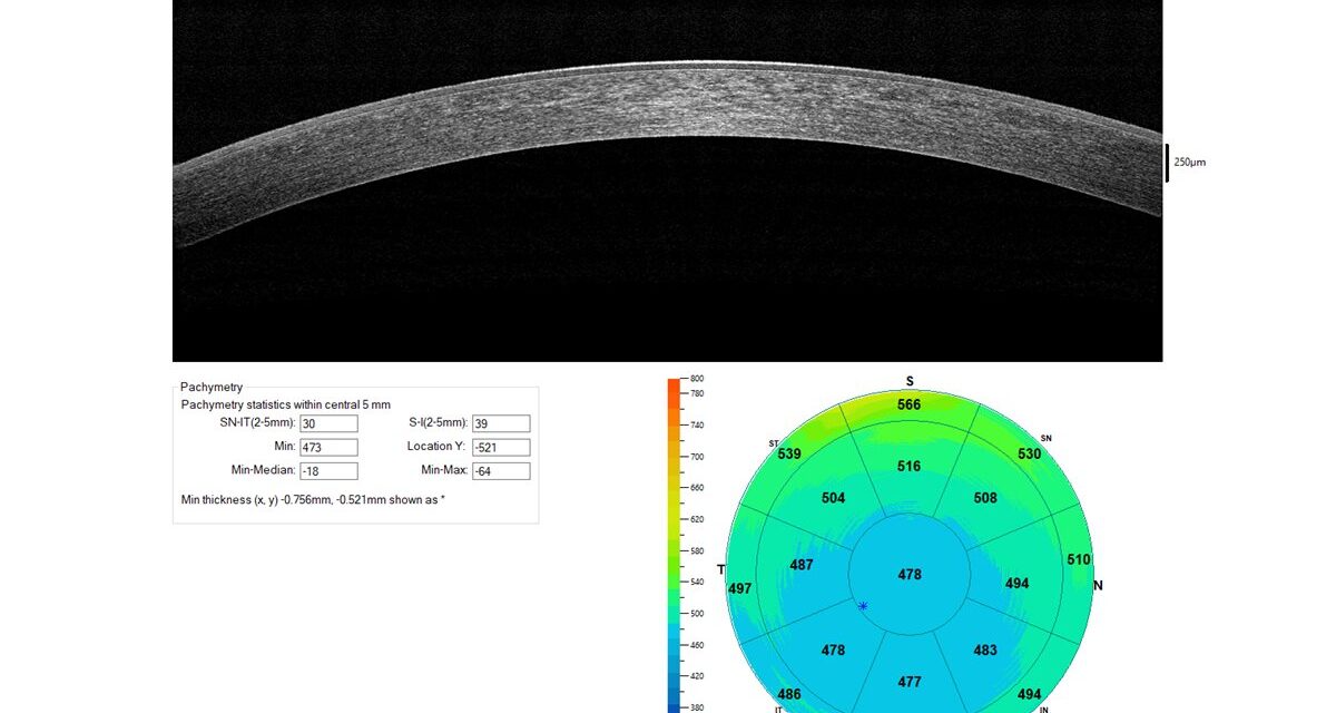 Corneal Pachymetry: A Small Number That Changes Several Big Decisions