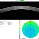 Corneal pachymetry: an anterior segment OCT cross-section of the cornea alongside a colour-coded regional pachymetry map showing corneal thickness values across the cornea