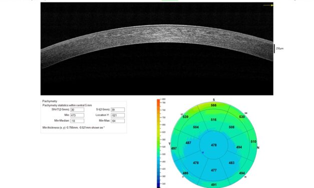 Corneal Pachymetry: A Small Number That Changes Several Big Decisions
