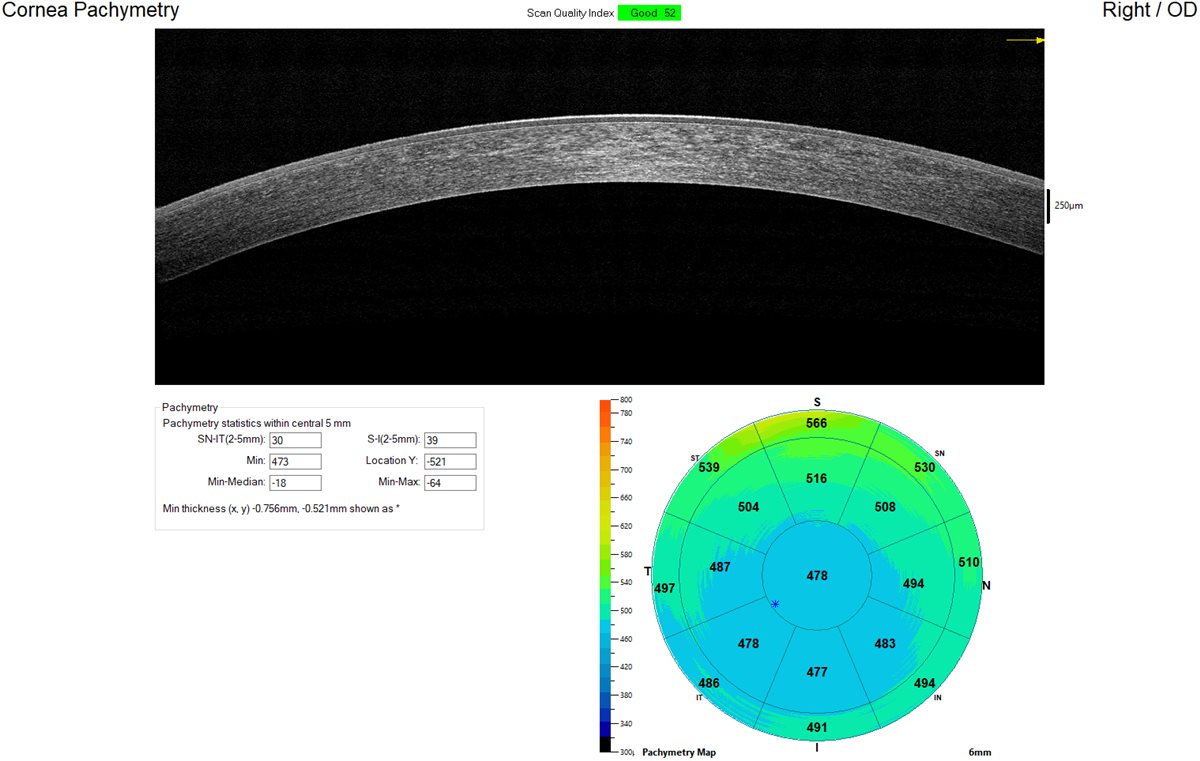 Corneal Pachymetry - OCT cross-section and thickness map Corneal pachymetry: an anterior segment OCT cross-section of the cornea alongside a colour-coded regional pachymetry map showing corneal thickness values across the cornea