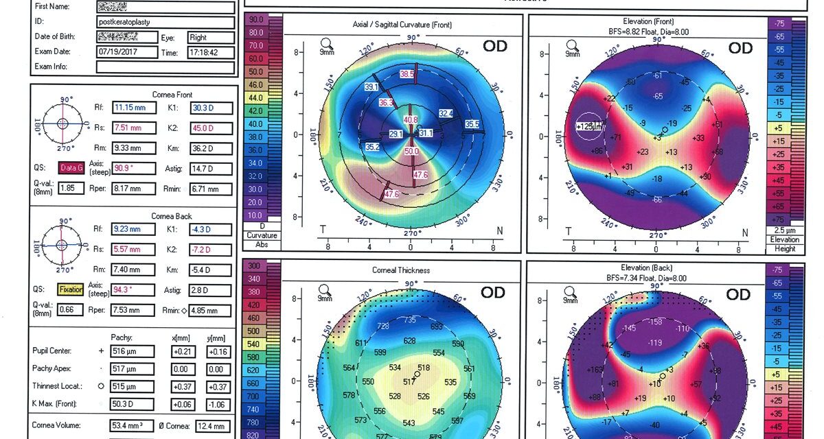 Corneal Topography: The Screening Step That Prevents Ectasia