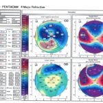 Corneal topography: a Scheimpflug-based four-map printout showing anterior corneal curvature, anterior and posterior elevation, and corneal thickness maps of an eye after penetrating keratoplasty