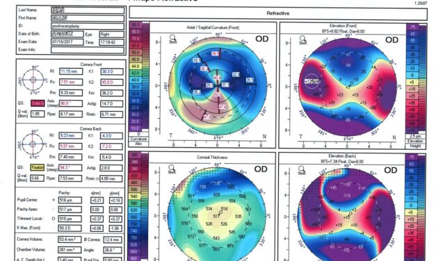 Corneal Topography: The Screening Step That Prevents Ectasia