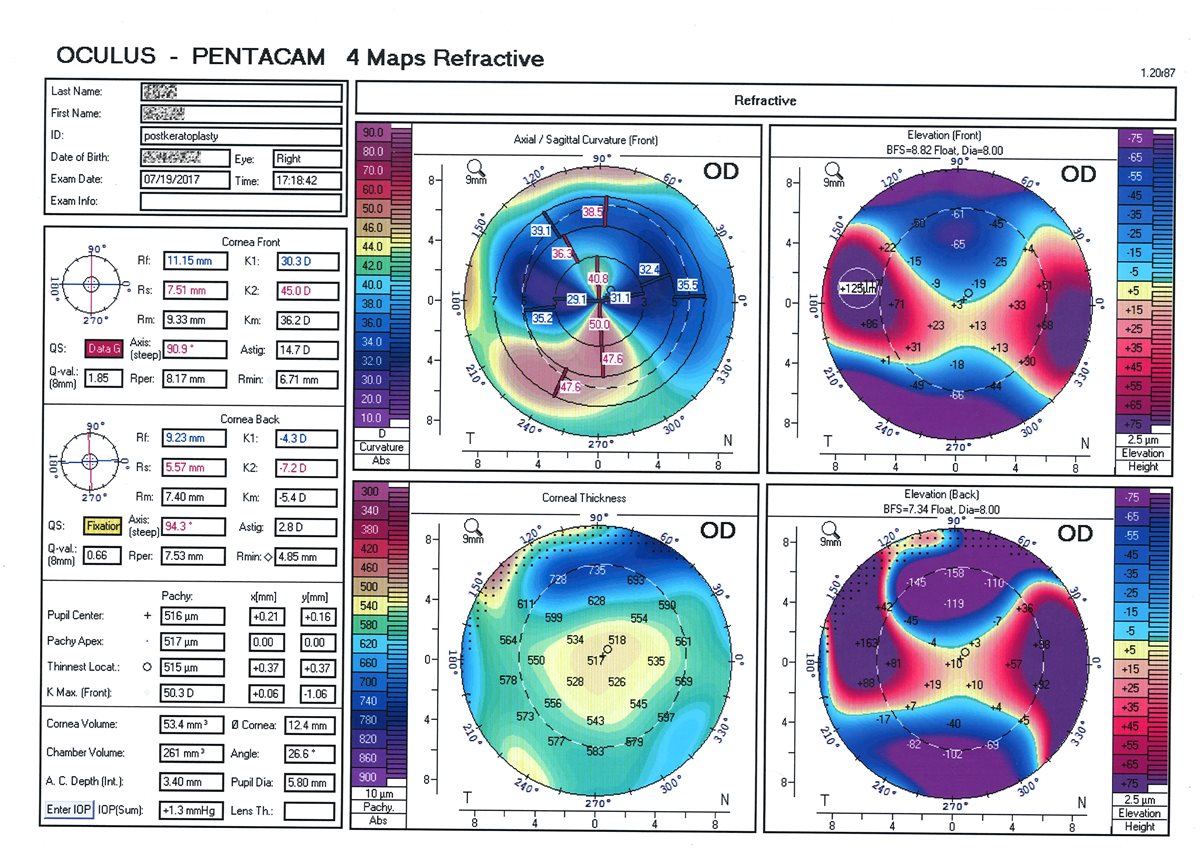 Corneal Topography - Scheimpflug curvature and elevation maps Corneal topography: a Scheimpflug-based four-map printout showing anterior corneal curvature, anterior and posterior elevation, and corneal thickness maps of an eye after penetrating keratoplasty