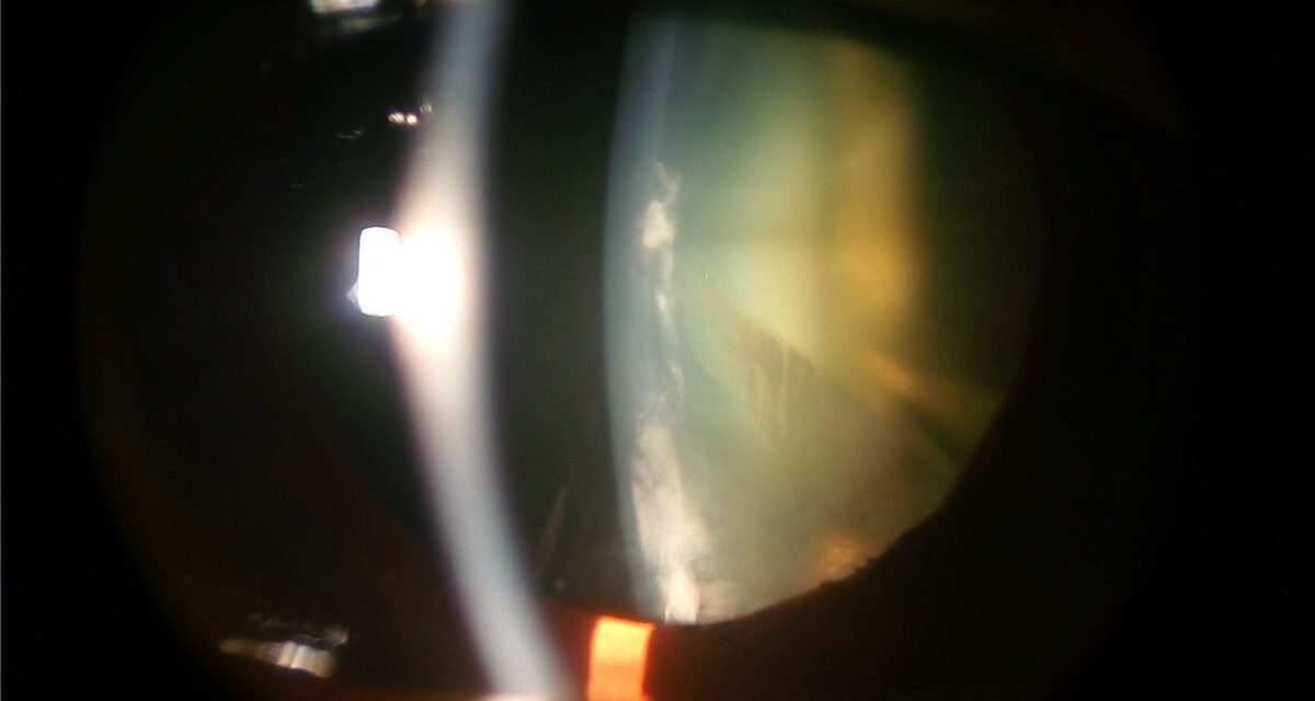 Cortical Cataract: Why Glare Can Outpace the Acuity Chart
