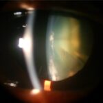 Cortical cataract: a slit-lamp photograph showing a wedge-shaped, spoke-like opacity extending from the lens periphery toward the centre, the characteristic pattern of cortical lens fibre degeneration