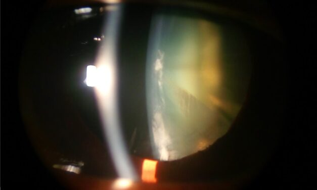 Cortical Cataract: Why Glare Can Outpace the Acuity Chart