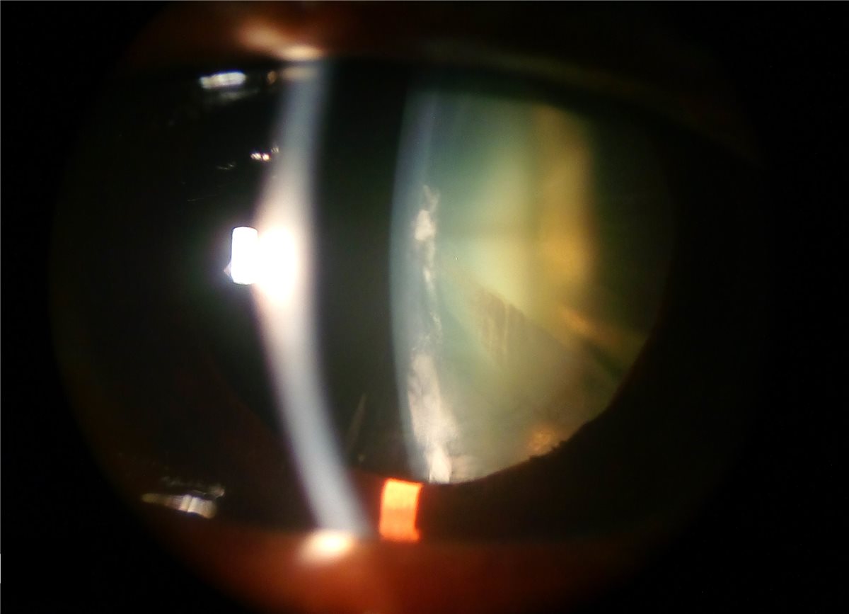 Cortical cataract: a slit-lamp photograph showing a wedge-shaped, spoke-like opacity extending from the lens periphery toward the centre, the characteristic pattern of cortical lens fibre degeneration