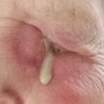 Dacryocystitis: tender, erythematous swelling centered over the lacrimal sac at the medial canthus with visible purulent discharge expressed from the punctum