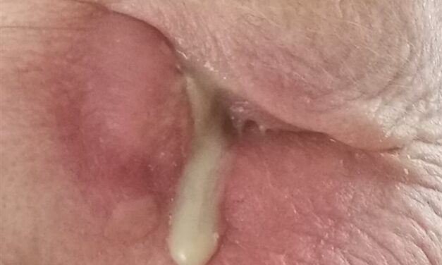 Dacryocystitis: When a Blocked Tear Duct Becomes an Infection
