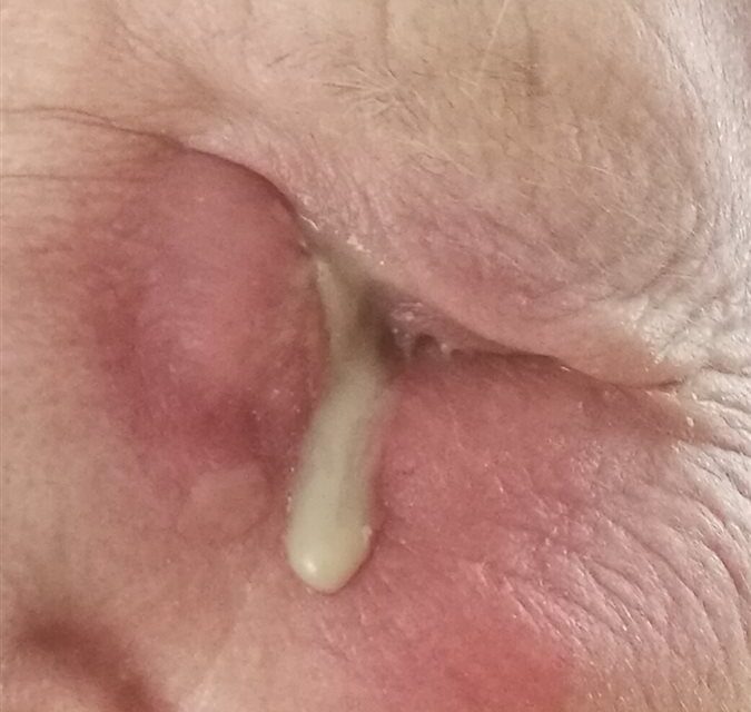 Dacryocystitis: When a Blocked Tear Duct Becomes an Infection