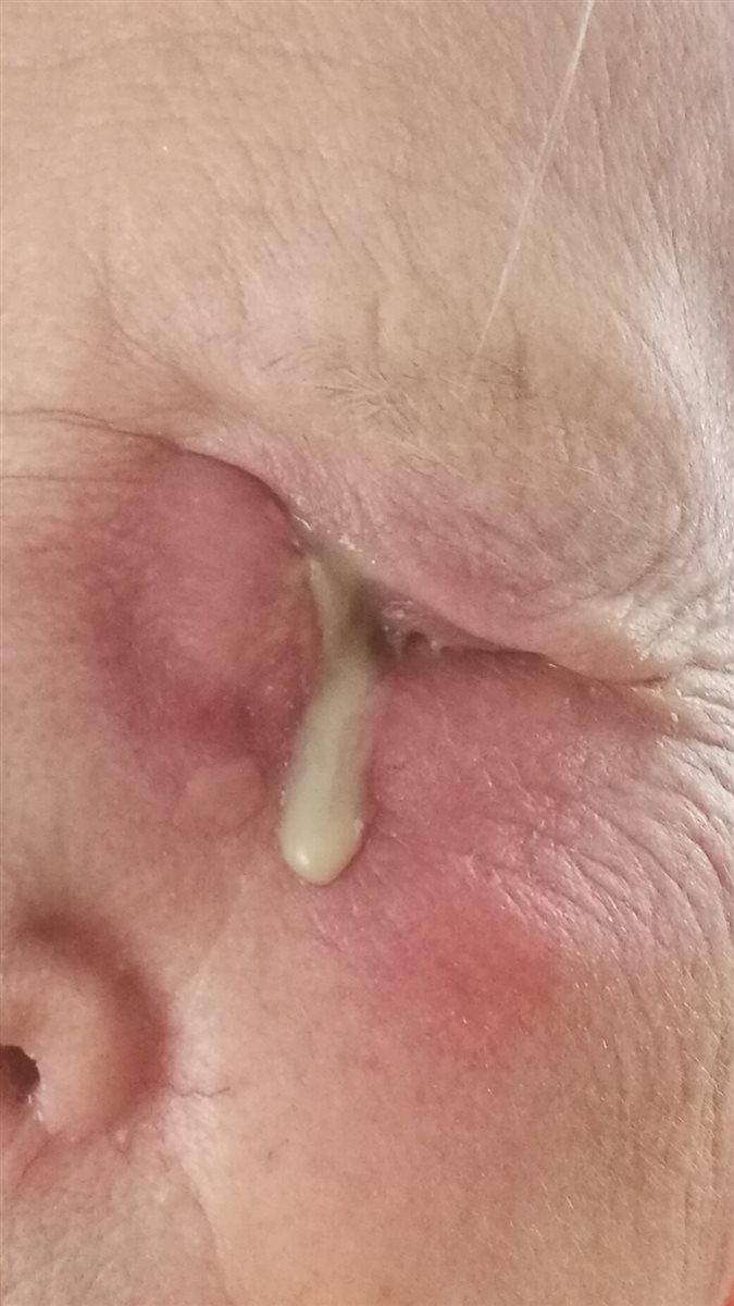 Dacryocystitis: tender, erythematous swelling centered over the lacrimal sac at the medial canthus with visible purulent discharge expressed from the punctum