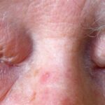 Dermatochalasis: bilateral redundant, lax upper eyelid skin folds hanging over the lid margins in an elderly patient