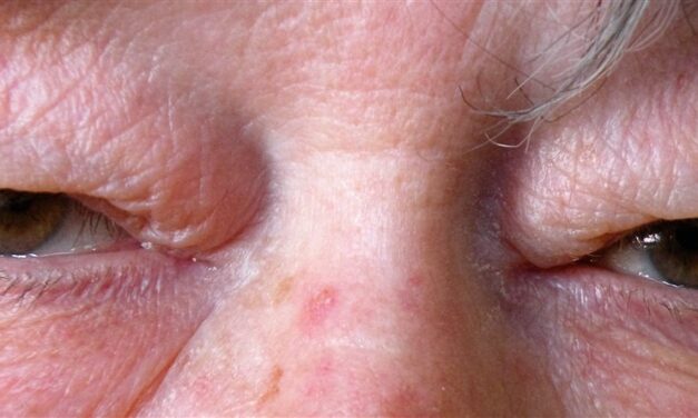 Dermatochalasis: The Heavy Eyelid That Isn’t Ptosis