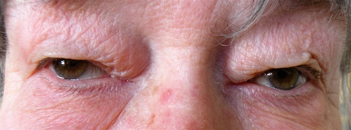 Dermatochalasis - redundant upper eyelid skin Dermatochalasis: bilateral redundant, lax upper eyelid skin folds hanging over the lid margins in an elderly patient