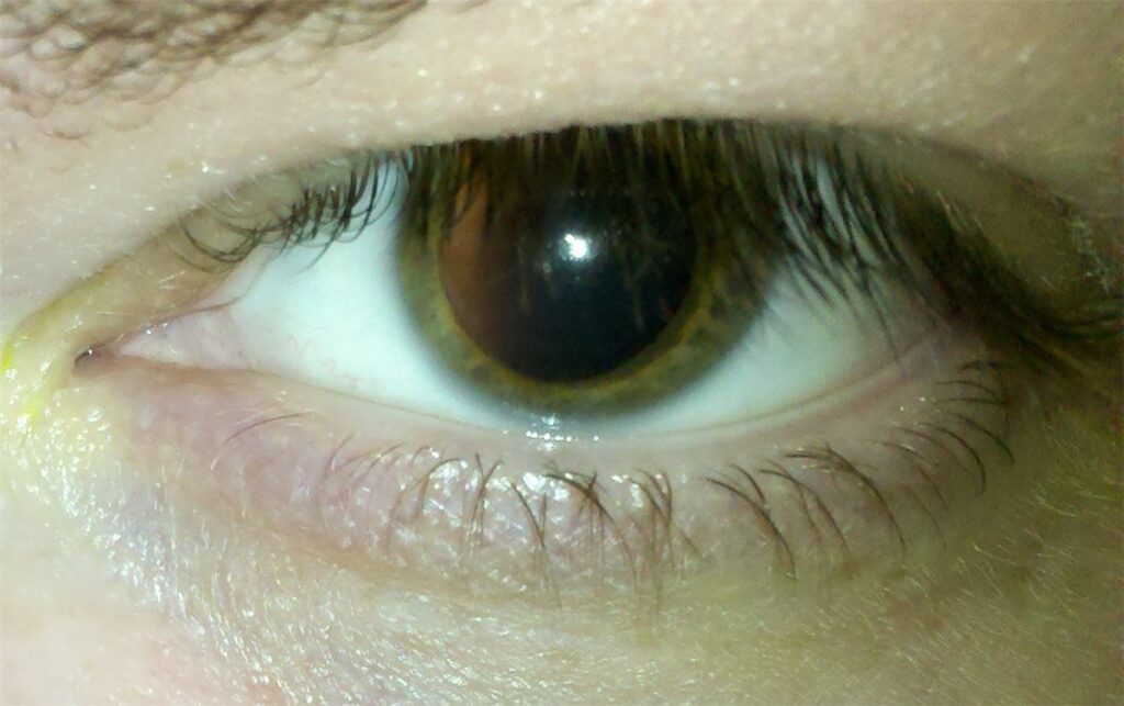 A close-up of a human eye with a fully dilated pupil after mydriatic drops, the pupil dilation required before indirect ophthalmoscopy or a dilated fundus examination
