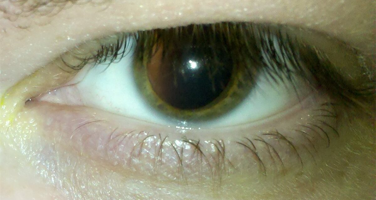 Indirect Ophthalmoscopy: The Stereoscopic View That Still Finds What Photographs Miss