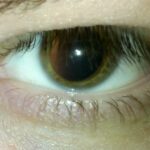 A close-up of a human eye with a fully dilated pupil after mydriatic drops, the pupil dilation required before indirect ophthalmoscopy or a dilated fundus examination