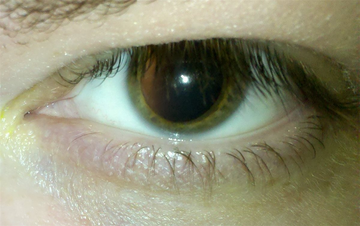 A close-up of a human eye with a fully dilated pupil after mydriatic drops, the pupil dilation required before indirect ophthalmoscopy or a dilated fundus examination