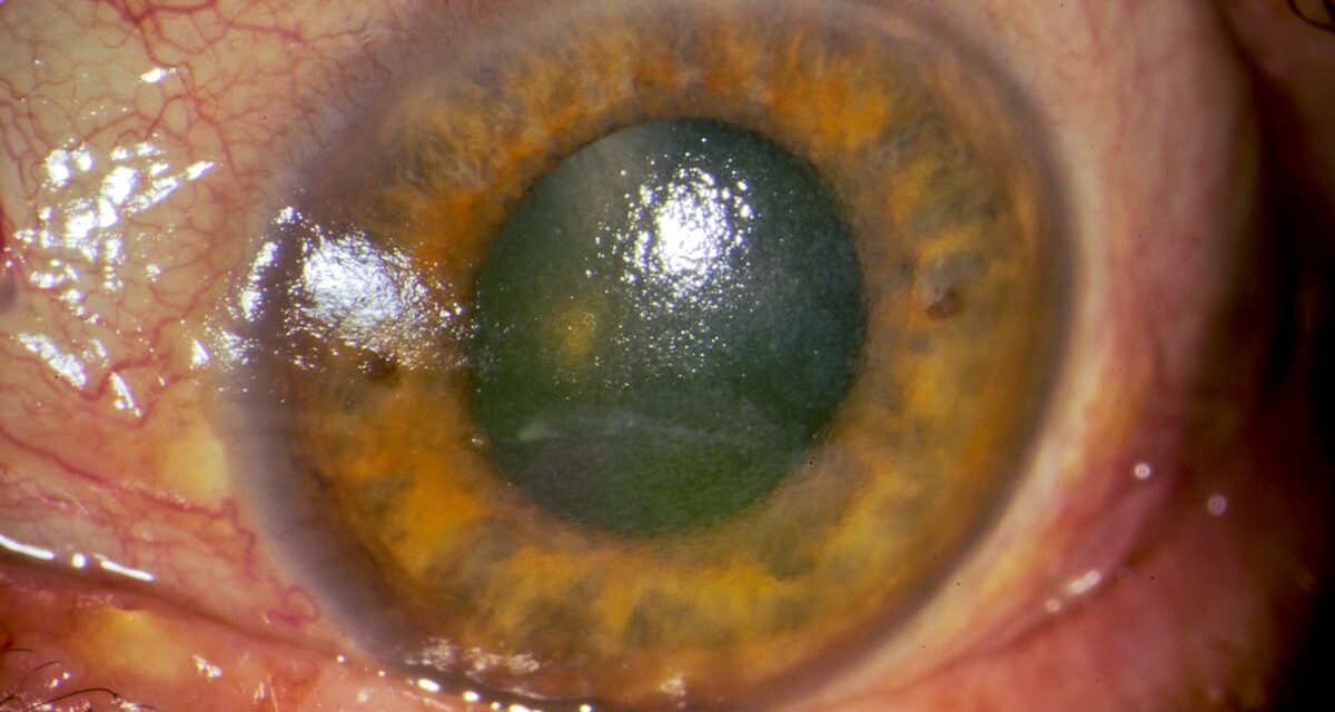 Dry Eye Disease: A Spectrum, Not a Single Diagnosis
