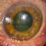 Dry eye disease: conjunctival injection with a dull, irregular corneal light reflex reflecting an unstable tear film and corneal epithelial surface irregularity