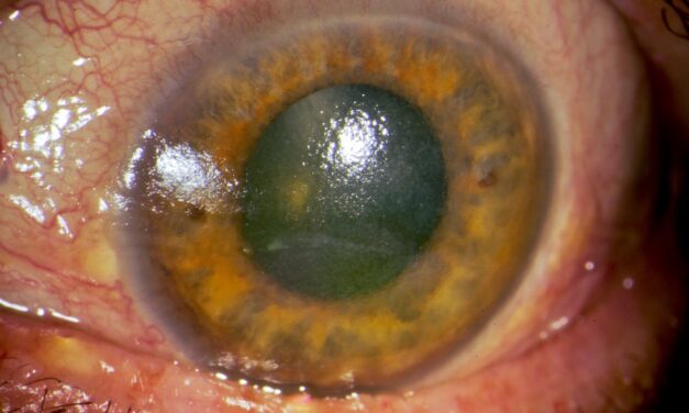 Dry Eye Disease: A Spectrum, Not a Single Diagnosis