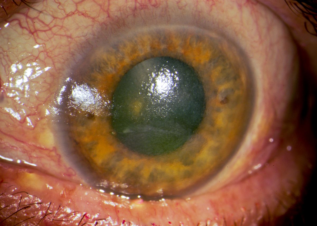 Dry eye disease: conjunctival injection with a dull, irregular corneal light reflex reflecting an unstable tear film and corneal epithelial surface irregularity