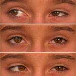 Duane retraction syndrome: a montage of a childs eyes in different positions of gaze, used to demonstrate the abnormal horizontal eye movement pattern of Duane syndrome type I