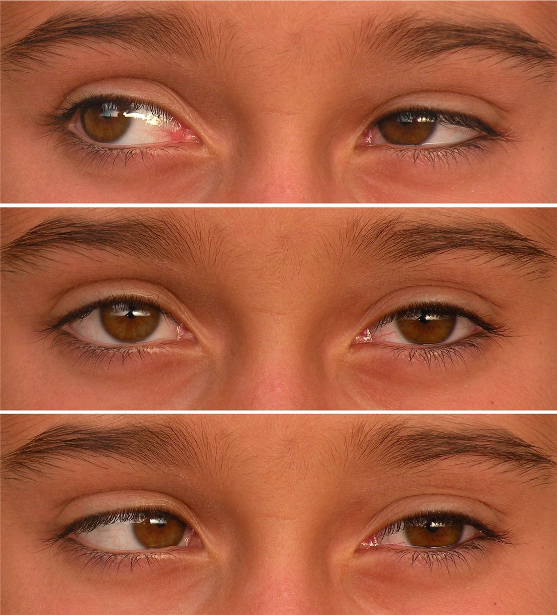 Duane retraction syndrome: a montage of a childs eyes in different positions of gaze, used to demonstrate the abnormal horizontal eye movement pattern of Duane syndrome type I