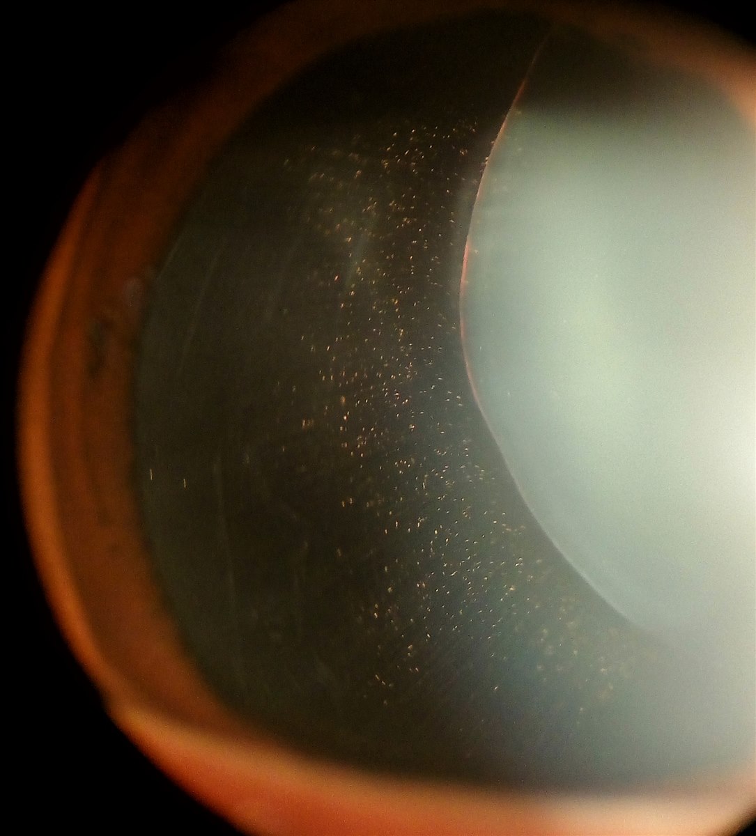 Ectopia lentis: the edge of a superiorly subluxated lens is visible crossing the pupil in Marfan syndrome