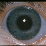 Ehlers-Danlos syndrome: a close-up of the eye showing a distinctly blue-grey scleral hue from thinning of the underlying collagen-deficient sclera