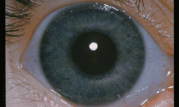 Ehlers-Danlos Syndrome: Why the Blue Sclera Is Not Always the Real Risk