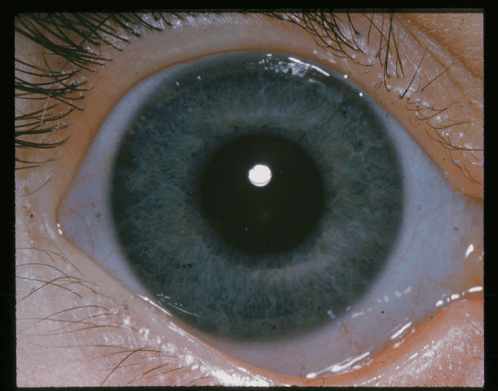 Ehlers-Danlos Syndrome: Why the Blue Sclera Is Not Always the Real Risk