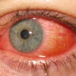 Epidemic keratoconjunctivitis: intense diffuse bulbar conjunctival injection with chemosis and watery discharge in acute adenoviral conjunctivitis