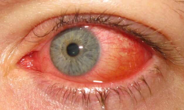 Epidemic Keratoconjunctivitis: The Red Eye That Spreads Through the Waiting Room