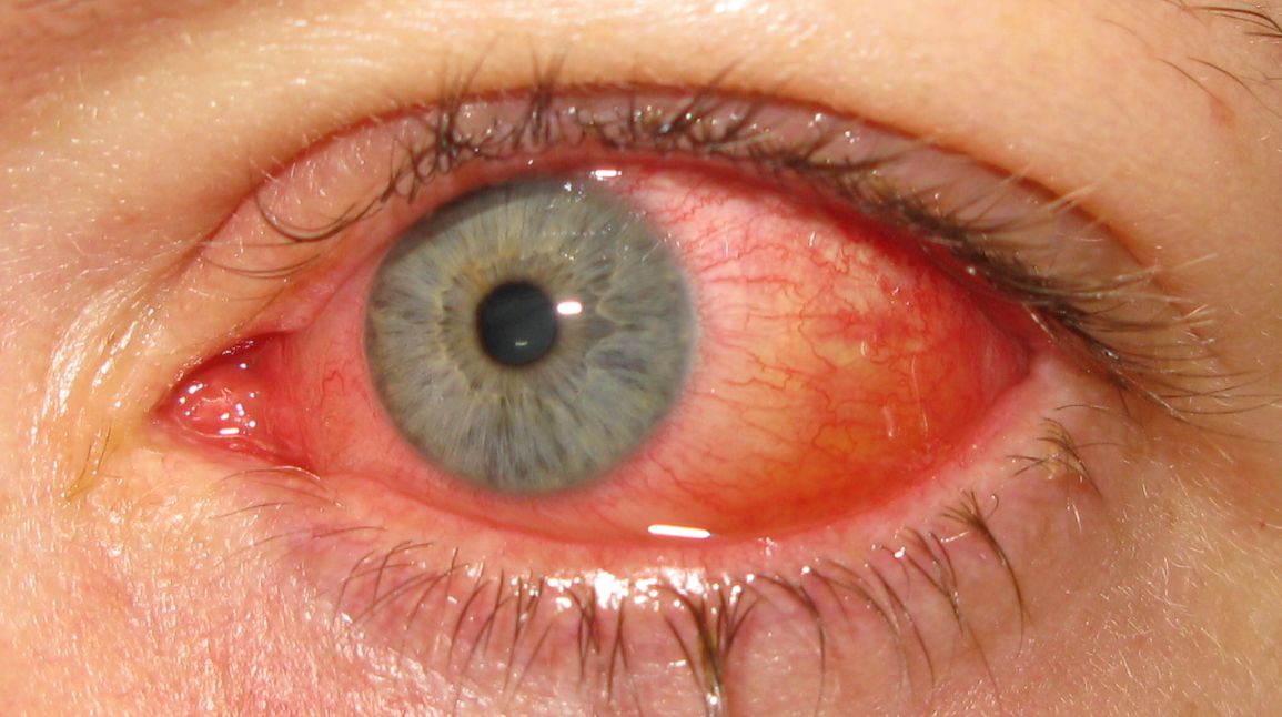 Epidemic Keratoconjunctivitis - diffuse conjunctival injection Epidemic keratoconjunctivitis: intense diffuse bulbar conjunctival injection with chemosis and watery discharge in acute adenoviral conjunctivitis