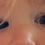 Esotropia: inward (nasal) deviation of one eye in a child, with an asymmetric corneal light reflex compared with the fixing eye