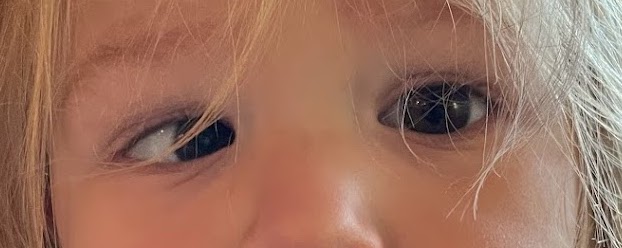 Esotropia: When Glasses Are the Cure and When They Are Not