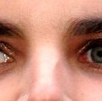 Exotropia: one eye deviated outward relative to the fellow fixating eye