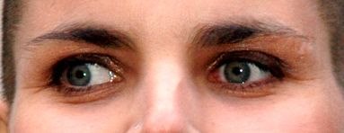 Exotropia: Intermittent vs. Constant Outward Deviation