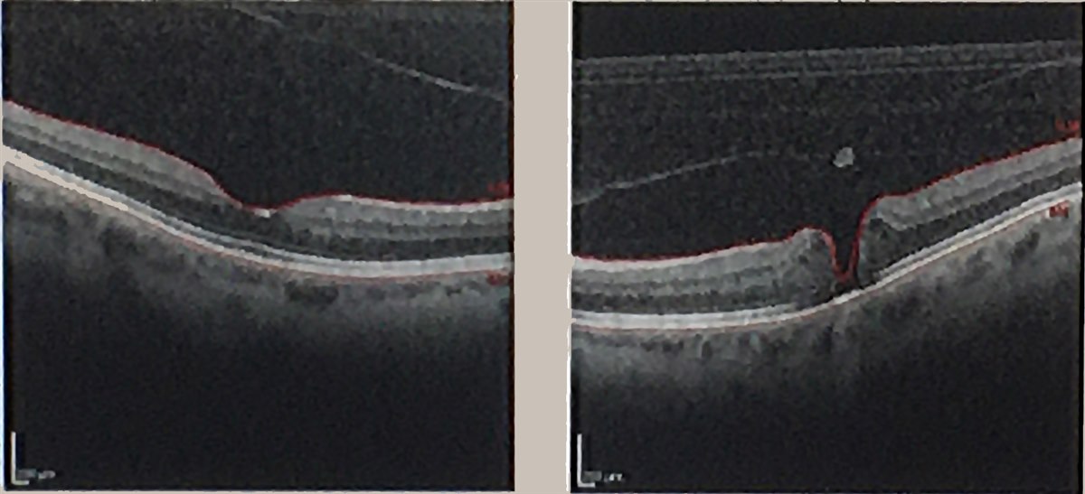Full-Thickness Macular Hole OCT Macular hole: OCT cross-section showing a full-thickness defect in the fovea compared with a normal fovea